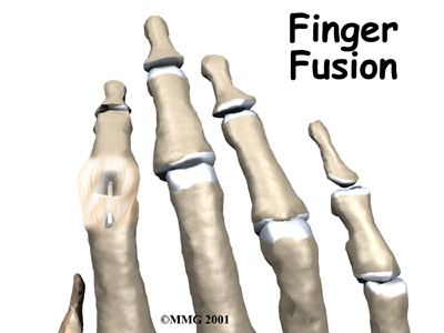 Finger Fusion Surgery - Momentum Spine & Sport Physiotherapy's Guide
